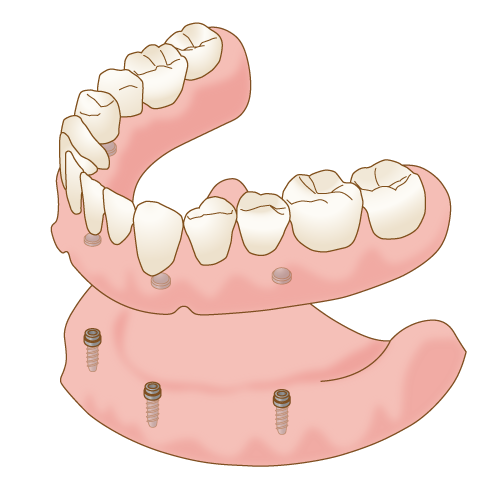 インプラントオーバーデンチャーの総入れ歯
